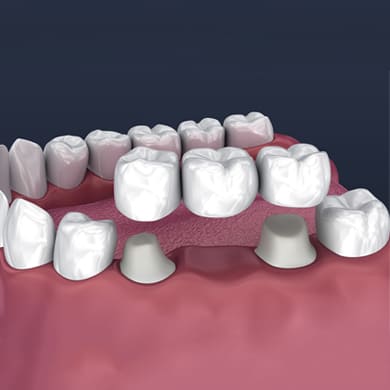 Dental Bridges