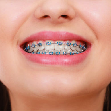 Teeth Braces